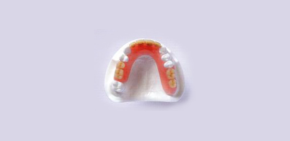 局部床義歯